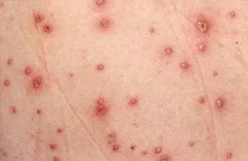 水痘的继发细菌感染可造成面部疤痕,或引起坏死性筋膜炎或败血症.