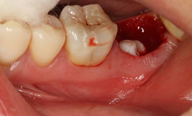 多见于上颌埋伏尖牙压迫中切牙牙根吸收,下颌埋伏智齿导致第二磨牙