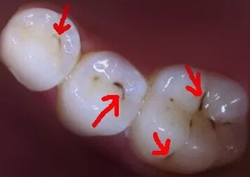牙菌斑?牙石是牙齿上面黑黑的东西吗?