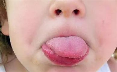 判断:如果舌头,舌边发红了,这是上火的症状,说明宝宝有心火!