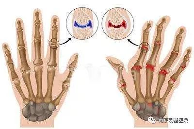 正常手指与类风湿性关节炎的对比图