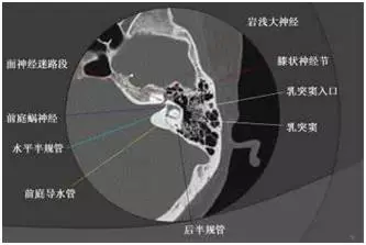 解剖复杂,构造精细,颞骨ct不仅能清楚显示中耳听小骨,面神经,鼓室盖