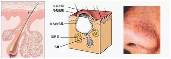 黑头太严重怎么办