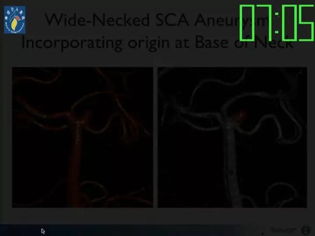 neuroform atlas支架治疗颅内动脉瘤