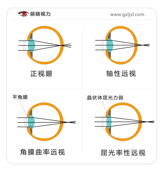 儿童远视是怎么形成的?有办法治疗吗?