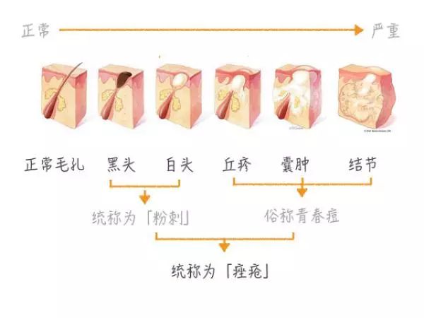 黑头太严重怎么办