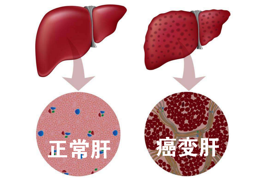 日常做到3点,肝脏健康一辈子