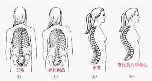 脊椎骨以及小关节恢复到正常生理位置及正常生理曲线从而达到康复的