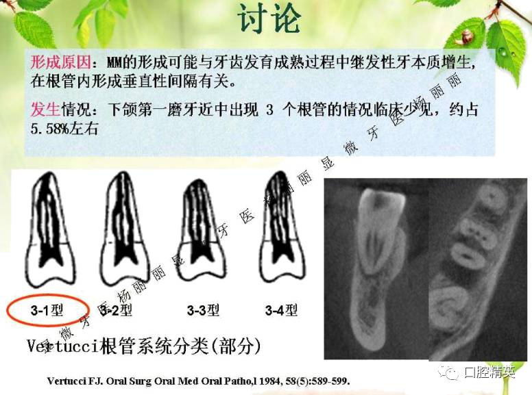 下颌第一磨牙 3根管治疗体会