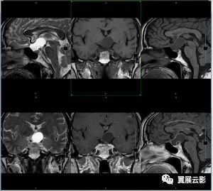 正确答案及鉴别诊断请下翻正确答案:b,颅咽管瘤影像描述鞍区哑铃型