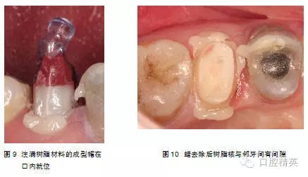 上颌前牙区埋伏阻生牙正畸牵引的诊治体会