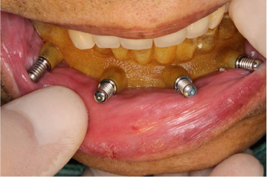 【数字牙科】郑州拜博彭布强院长无牙颌种植导板病例