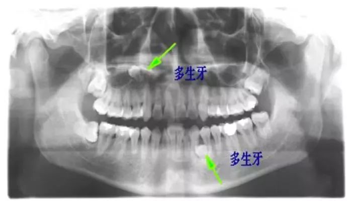 一生中必拔的七颗牙!你有几颗?