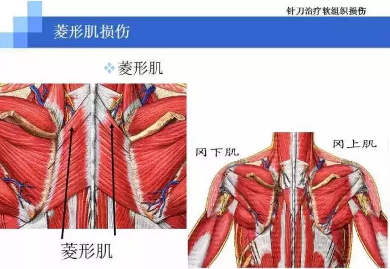 病因及诊断:因为菱形肌位于斜方肌及上后锯肌中间