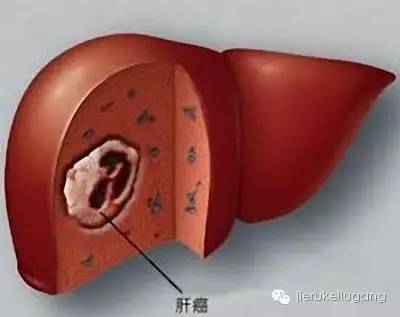 由于肝癌患者常为继发于肝硬化的原发性肝癌,且患者就诊时多为晚期,且