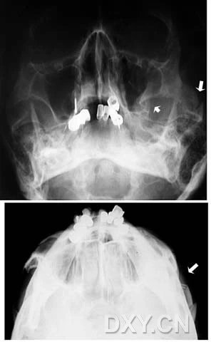 颧上颌骨折颌骨纤维性结构不良症涎石病骨肉瘤根尖囊肿鼻鄂囊肿成釉