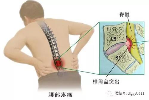 健康 正文  腰椎间盘突出患者出现麻痹症状是因为病灶压迫到了神经,这