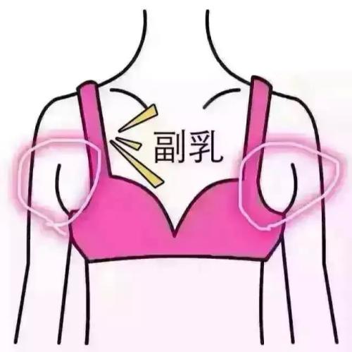 乳房疼,未必是乳腺发炎,小心副乳要了你的命!