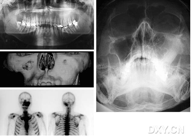 口腔常见疾病影像大全(建议收藏) 成釉细胞瘤  大理石骨病  (骨端