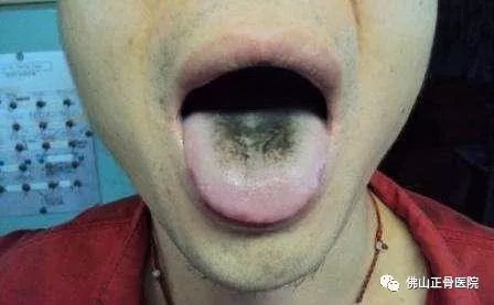 舌头发白严重,是肾不好的前兆吗?