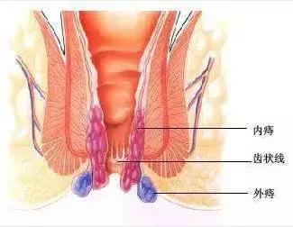 健康 正文  痔核脱出:由于痔疮的体积增大,排便时受粪便挤压,使其逐渐