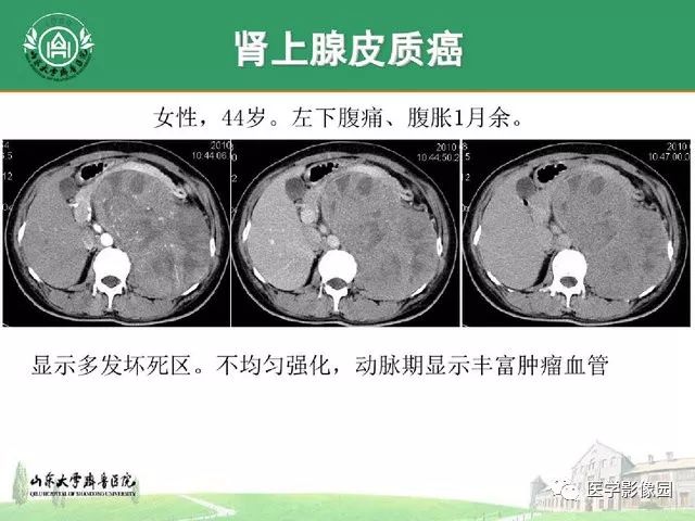 肾上腺皮质肿瘤