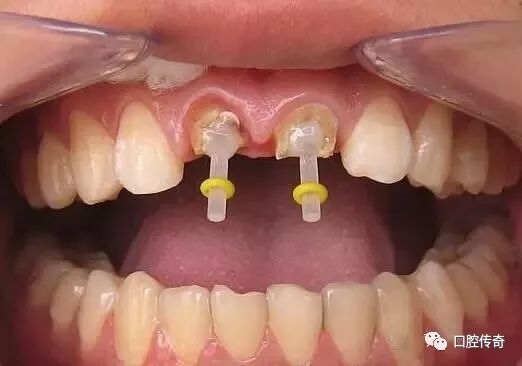 【口腔实用】教你如何向患者解释牙齿打桩!
