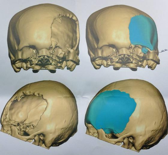 "颅缺"-头上缺颅骨,到底补不补?