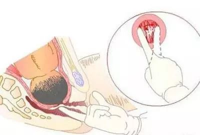 最尴尬内检全记录!原来医生这样检查开宫口?