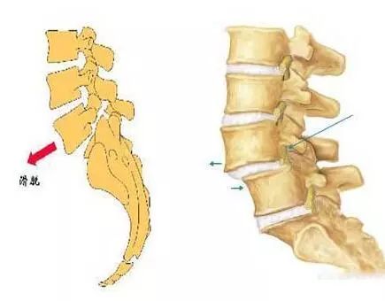 腰椎间盘突出的 退变会导致 腰椎不稳和关节突出现 骨关节炎.