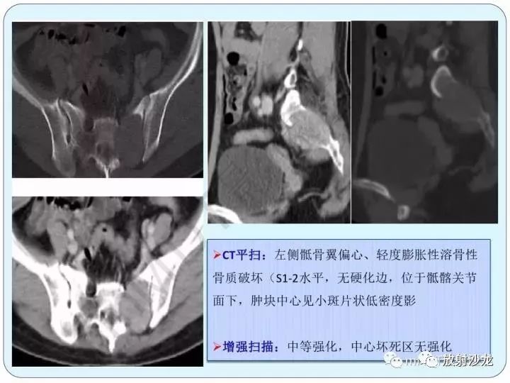 骶骨骨巨细胞瘤影像诊断