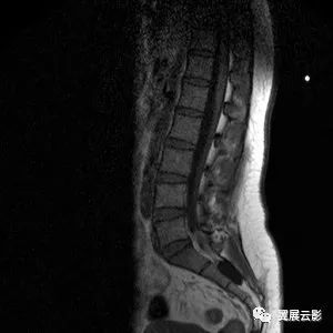 【经典病例】椎管内脊膜囊肿一例