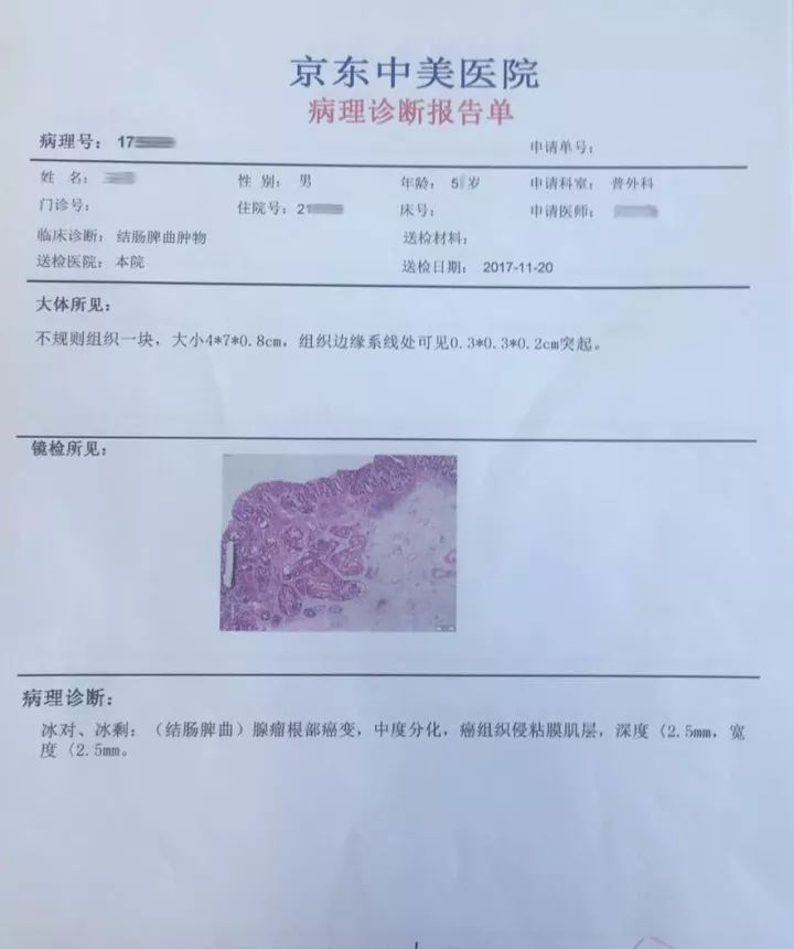 术后病理回示后转入普外科于11月20日行肠镜辅助 腹腔镜横结肠肿物