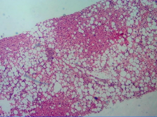 图1肝细胞广泛脂肪样变