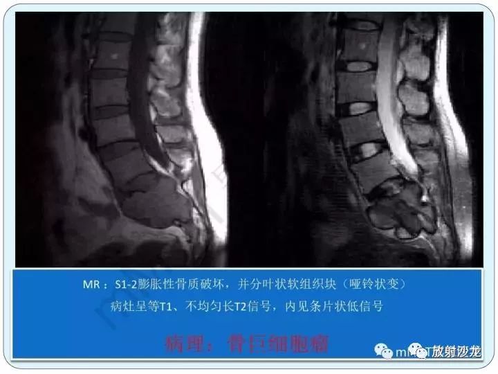 骶骨骨巨细胞瘤影像诊断