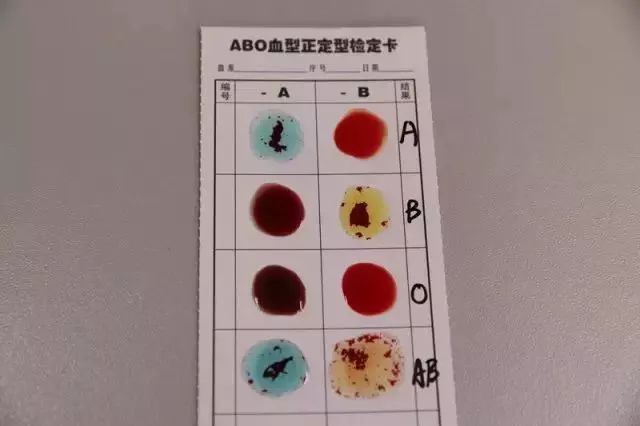它能使含有a抗原的血液(即包括a型与ab型)凝集; 浅黄色的抗b血型定型