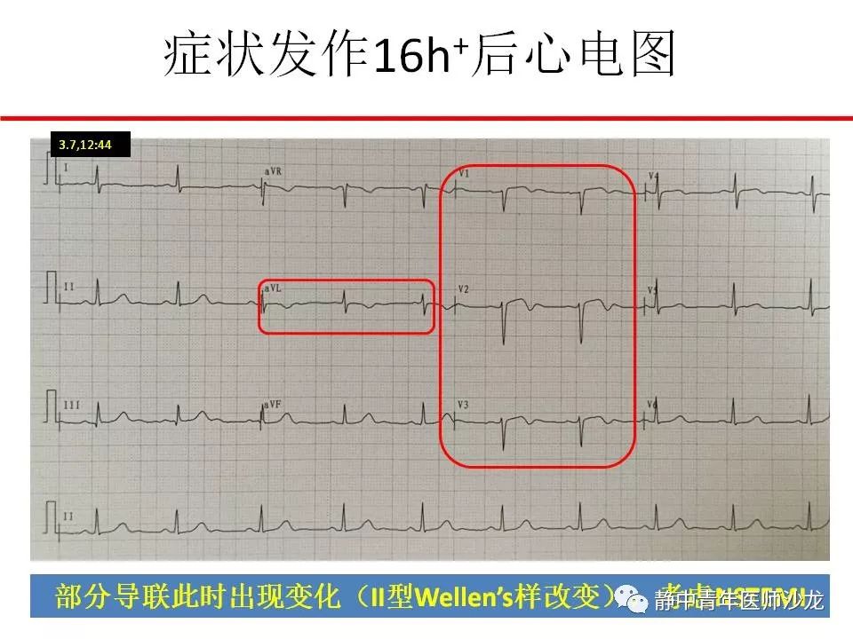 心肌梗死患者心电图特征临床分析