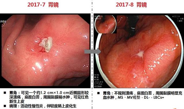 入院进一步检查 治疗计划 2017年9月以拟行"胃窦早ca"内镜下切除收入