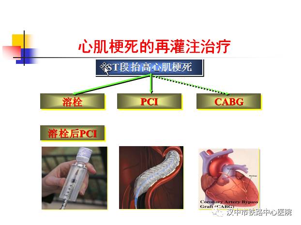 梗死心肌>30(大面积心梗 2h内抬高的st段迅速回降>50%或恢复至等