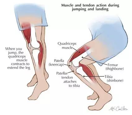 髌骨软化症——膝盖不能承受的痛!