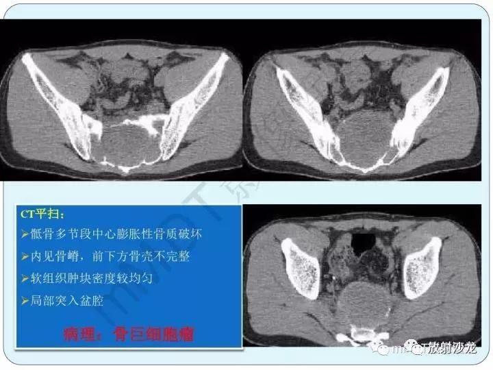 收藏骶骨骨巨细胞瘤影像诊断详细解读