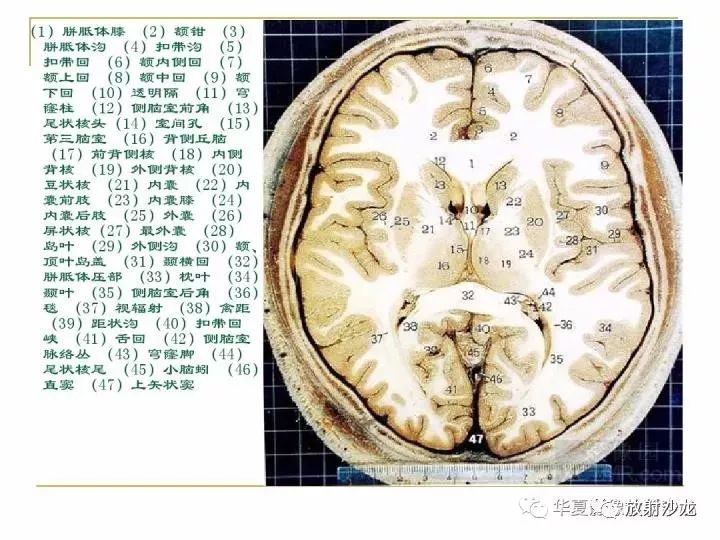 颅脑的断层解剖记不住?那么,你需要收藏下这个