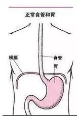 我们来看一组截面图,就能知道患上食道裂孔疝后,食管和