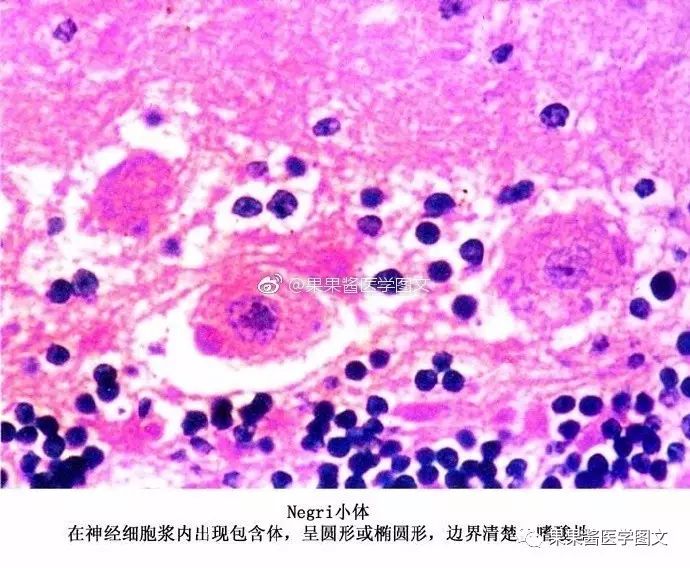 lewy小体parkinson病中镜下可见该处的神经黑色素细胞丧失,残留的神经