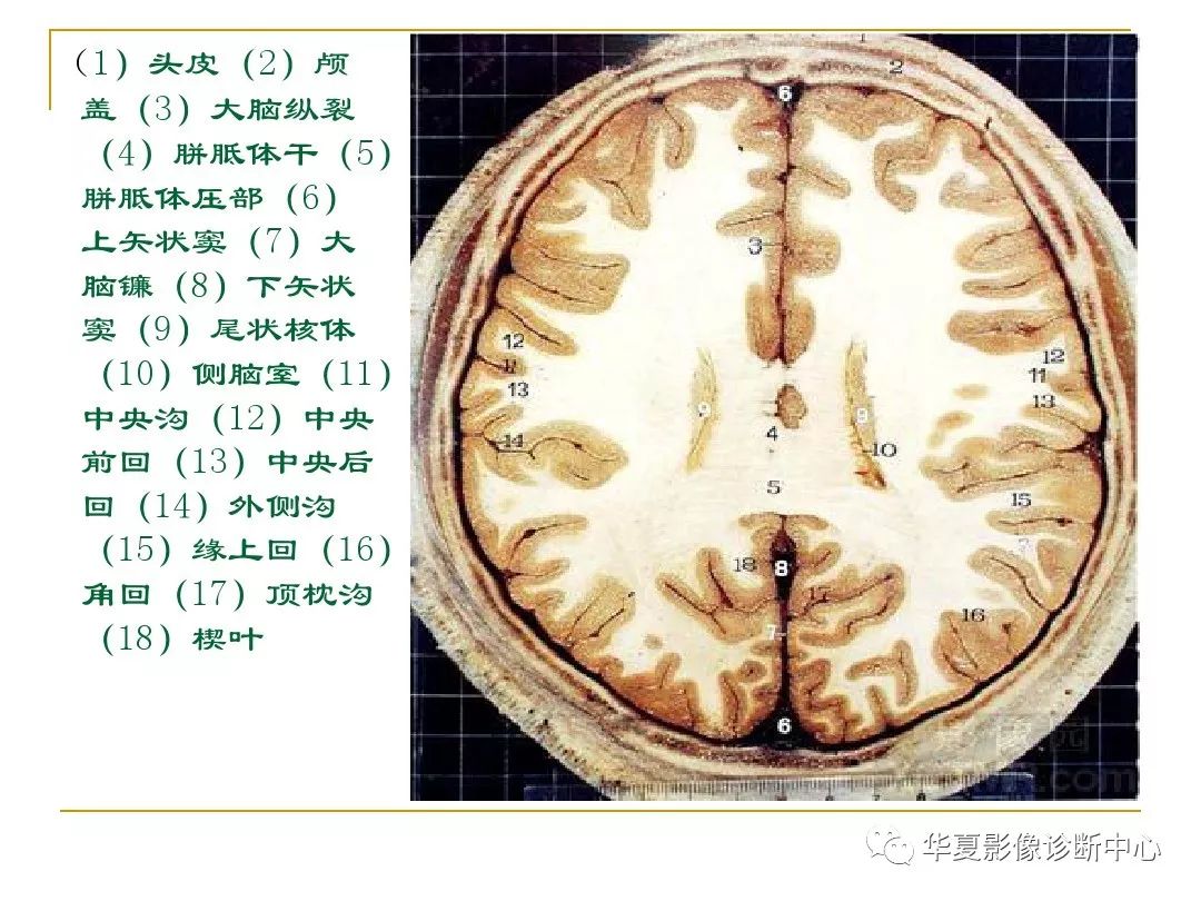 颅脑的断层解剖记不住那么你需要收藏下这个