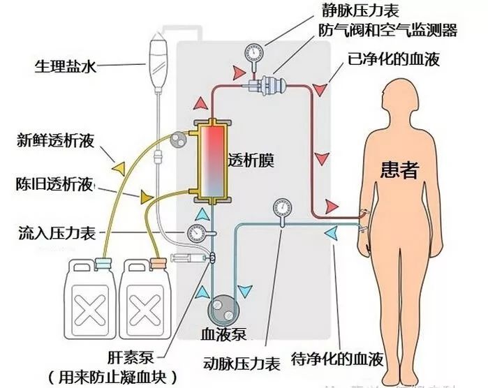 糖尿病的人透析是什么原理_什么是糖尿病图片