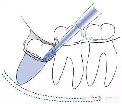 健康 正文  对于普通的牙齿,拔牙的过程通常比较快,对于那些埋在牙龈