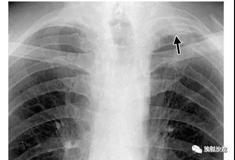 x线诊断要点丨气胸胸膜及胸壁病变