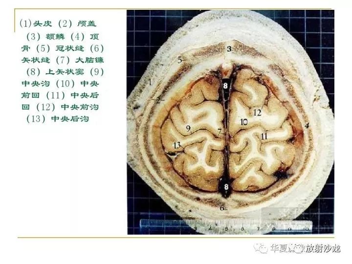 颅脑的断层解剖记不住?那么,你需要收藏下这个