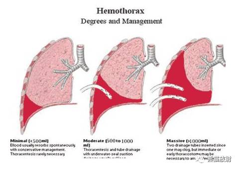 x线诊断要点丨气胸胸膜及胸壁病变